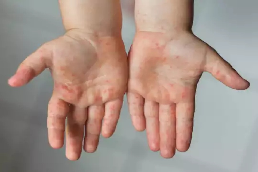 hand_foot_and_mouth_disease.jpg